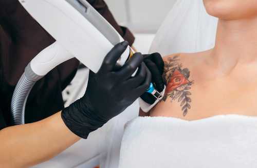 Kosten tatoeage verwijderen